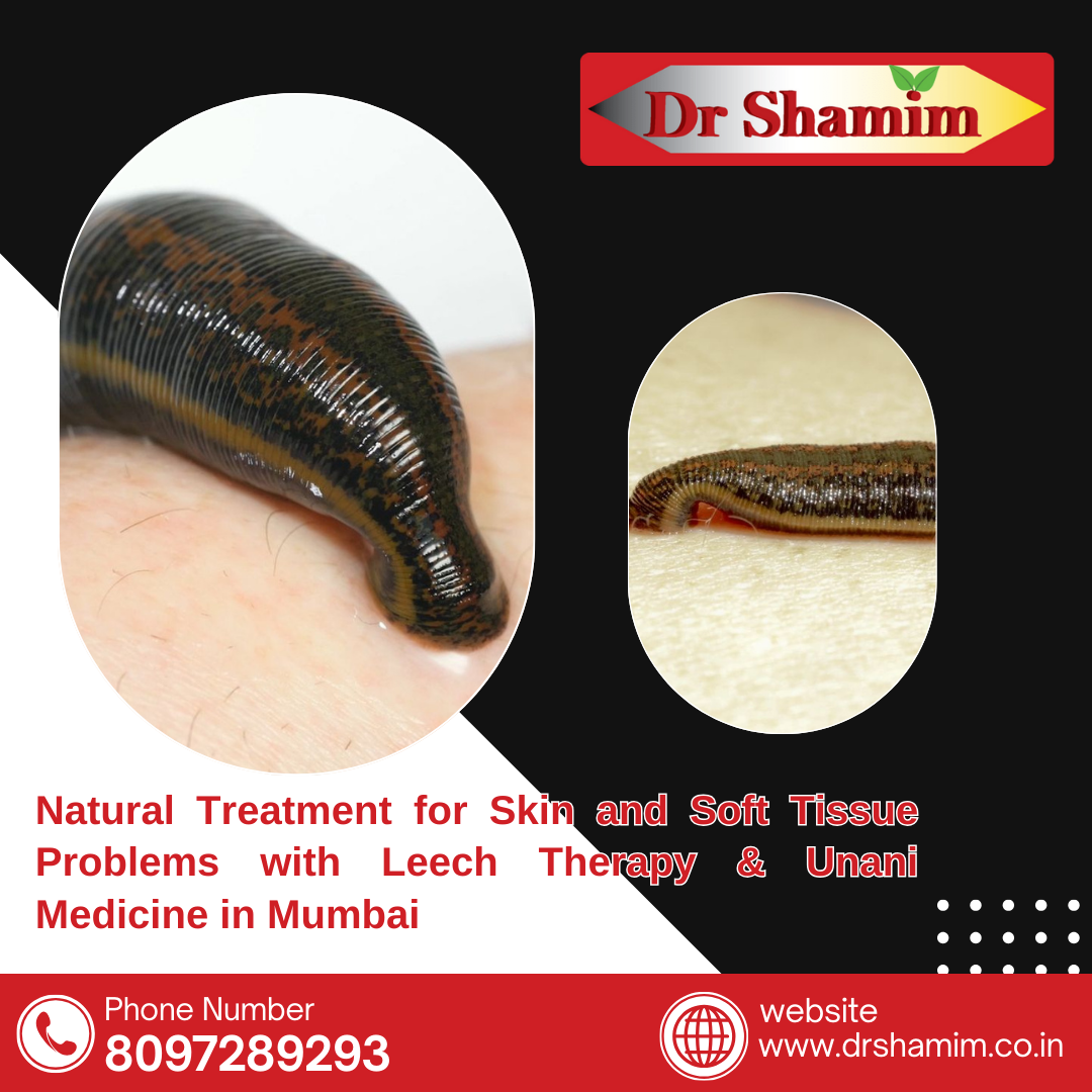  Natural Treatment for Skin and Soft Tissue Problems with Leech Therapy & Unani Medicine in Mumbai
